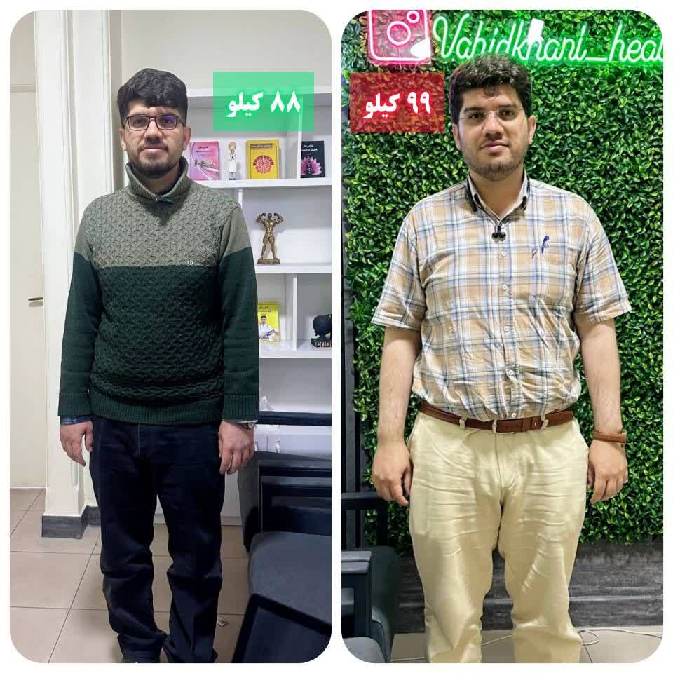 اسلیو معده بدون جراحی