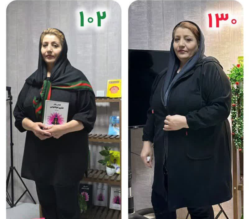 اسلیو معده بدون جراحی