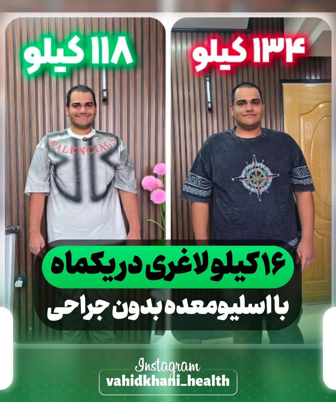 🌟 کاهش ۷ کیلوگرمی میثم در یک هفته؛ تجربه موفق اسلیو معده بدون جراحی