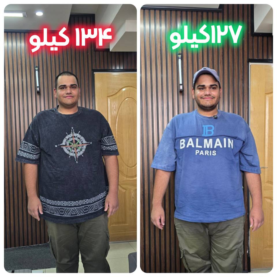 🌟 کاهش ۷ کیلوگرمی میثم در یک هفته؛ تجربه موفق اسلیو معده بدون جراحی