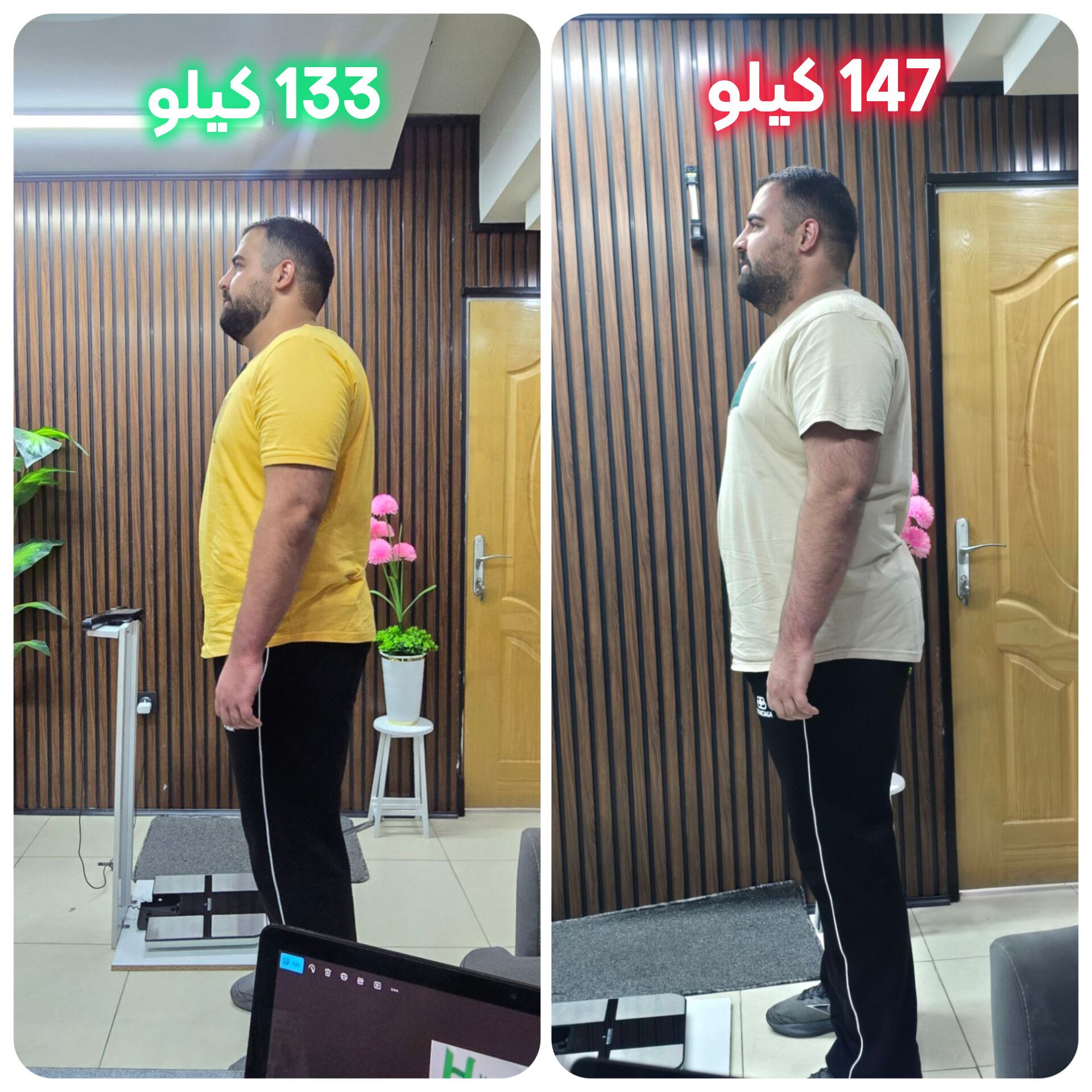 لاغری سریع با اسلیو معده بدون جراحی آقای علیرضا محمدی با وزن 147 کیلو