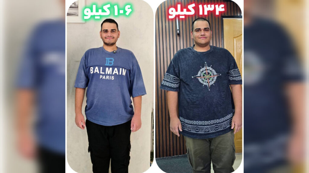🌟 کاهش ۷ کیلوگرمی میثم در یک هفته؛ تجربه موفق اسلیو معده بدون جراحی